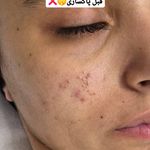 فیشال و پاکسازی تخصصی پوست سولماز
