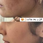 فشیال و پاکسازی پوست