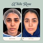 مرکز بلفاروپلاستی فوق تخصصی رز سفید