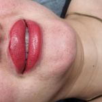 میکروبلیدینگ،فیبروز نسرین رضایی