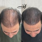 کلینیک تخصصی فاطمه وکیلی/ میکروبلیدینگ