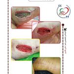 تیم تخصصی درمان زخم خانه سلامت