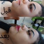 تزریق ژل و بوتاکس .انزیم