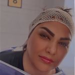 کاشت ابرو سلطانی متد پنج زاویه