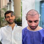 کاشت تخصصی مو،ابرو و ریش هاشمیان