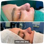 جراحی تخصصی بینی  گوشتی استخوانی