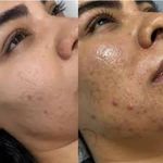 فیشیال تخصصی کلینیک زیبایی کوروش