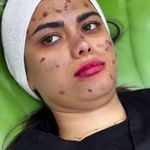 فیشیال تخصصی کلینیک زیبایی کوروش