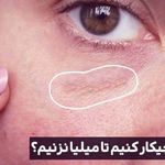 جشنواره بزرگ پلاسما تراپی و میکرو نیدلینگ تا پایان بهمن ماه