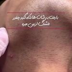 مرکز لیزر الکساندرایت کندلا