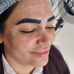 کلینیک هانیل | فیلر بوتاکس آنی‌لیفت شرق