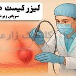 لیزر کیست مویی قمری