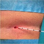 لیزر کیست مویی قمری