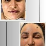 خدمات تخصصی فیشال و پاکسازی پوست صبا