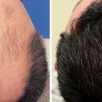 کلینیک زیبایی کاشت مو «پادرا بیوتی»