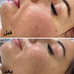 پاکسازی، فیشیال و جوانسازی نسترن