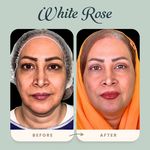 مرکز بلفاروپلاستی فوق تخصصی رز سفید
