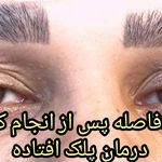 پلاسمای صورت  و چربی سوزی بینی