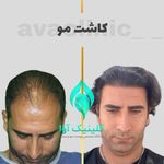 کلینیک تخصصی پوست و کاشت مو آوا