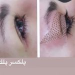 فیشال و پاکسازی. هایفو.پلاسماتراپی زهره