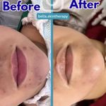 فشیال و اسکراب اسکالپ کلینیک بلا