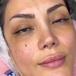 کاشت مژه هیدن ریحانه رجبی