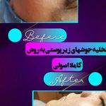 فیشیال و پاکسازی پوست مریم