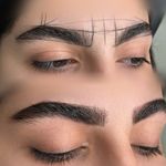 میکروبلیدینگ شیدینگ لب ساری و جویبار