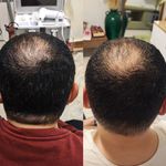 احیای فولیکول مو و ماساژ درمانی سرو گردن