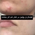 فشیال و پاکسازی پوست