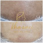فیشال و پاکسازی پوست درنواب