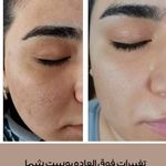 انجام خدمات مزونیدلینگ ، میکرونیدلینگ ،هایفو تراپی و ... (فیس بیوتی)