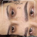 مرکز میکروبلیدینگ شیدینگ ریموو اسکالپ