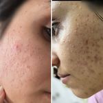 فشیال و پاکسازی تخصصی پوست