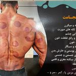 حجامت شعبانی زیر نظر پزشک