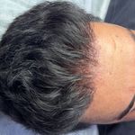 رفع تیرگی لب - اصلاح بدرنگی تتو قدیمی