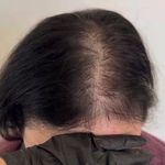 تتو بدن، فیبروز، تتو پزشکی، پیرسینگ رویا