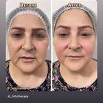 مرکز تخصصی لیزر موهای زائد و هایفو  فوبه
