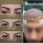 کاشت مو و ابرو در کلینیک شعبه اهر و سهند
