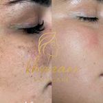 فیشال و پاکسازی پوست درنواب