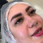 ریموو شیدینگ میکروبلیدینگ