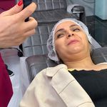 ریموو شیدینگ میکروبلیدینگ