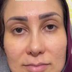 پاکسازی پوست اسکالپ اسکراب سر دکتر احمدی
