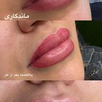 میکروکیماسی( میکروابرو چشم لب،ریمو)