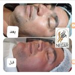 فیشیال و پاکسازی نگار