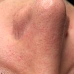 خدمات تخصصی پاکسازی و فیشال پوست