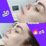 جوانسازی صورت و گردن