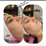 جوانسازی صورت و گردن