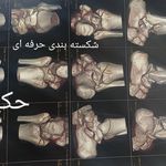 شکسته بندی، طب سنتی استادحکیم