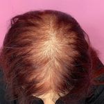 اسکالپ و میکرو اسکالپ سر خانم و آقا شادی